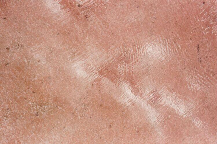 adult acne