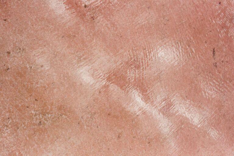 adult acne